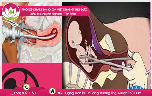 Địa chỉ nạo phá thai ở Bắc Ninh hỗ trợ thuốc an toàn ít đau hiệu quả nhanh