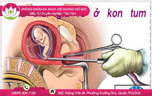Địa chỉ và phí phá thai ở Kon Tum giá rẻ lại an toàn nhất