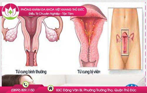 Nguyên nhân bệnh viêm nội mạc tử cung xuất hiện phổ biến ở nữ giới