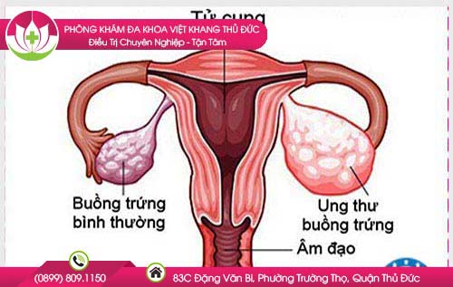 Tìm hiểu chi tiết về tình trạng viêm buồng trứng gây vô sinh ở phụ nữ
